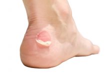 Comment éviter les ampoules ? 5 astuces efficaces comment éviter les ampoules