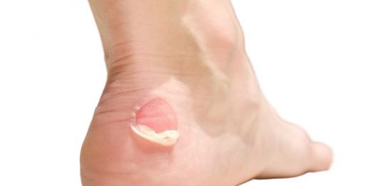 comment éviter les ampoules